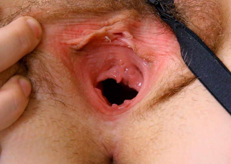 Из вагины торчит отросток