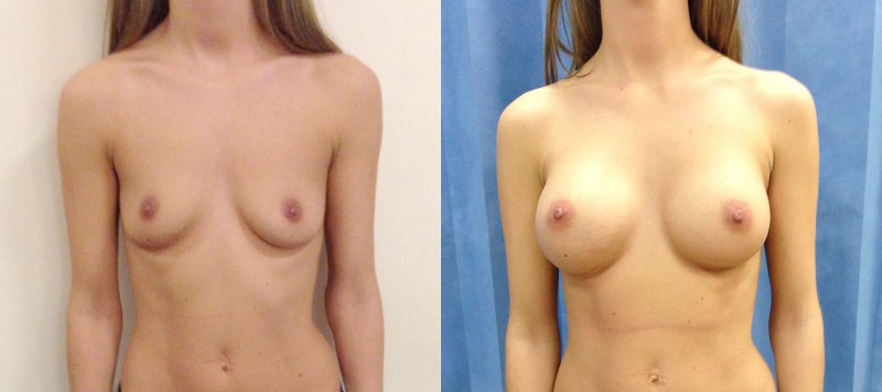 Голые сиськи второй размер форма треугольник