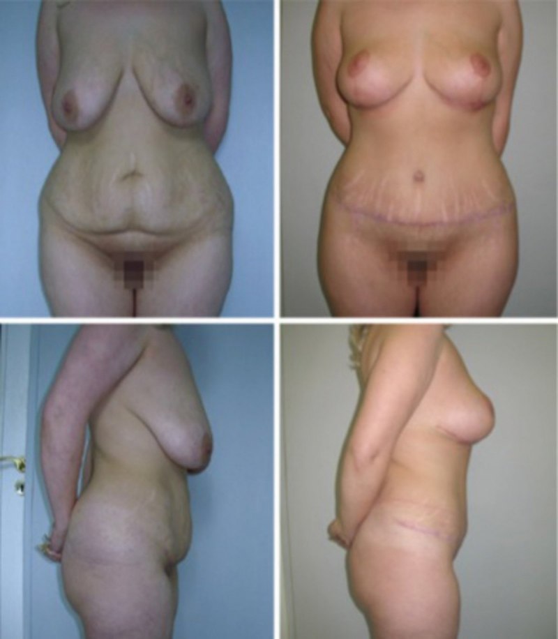 Отвисшие сиськи беременной