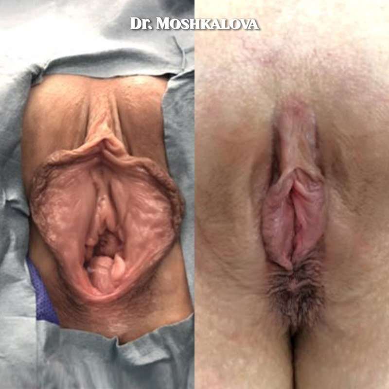 Пластическая операция вагины