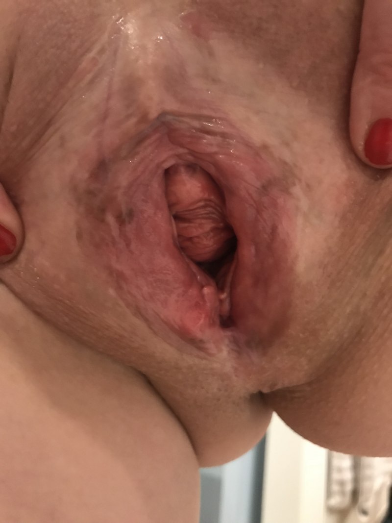 Biig poop Monster vagin gape prolapse cunt